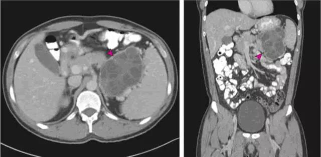 【病例】胰腺包虫性囊肿1例CT影像表现