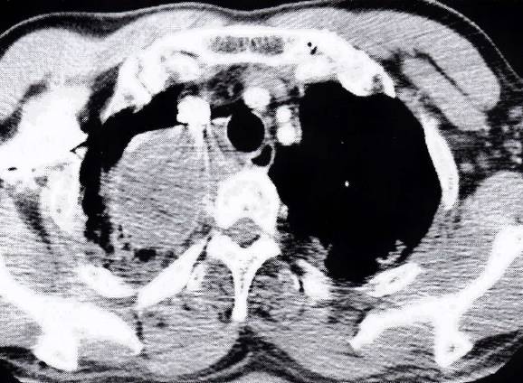 肺内神经鞘膜瘤的影像特点