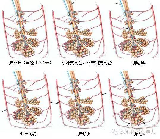 HRCT肺间质性改变的表现及意义