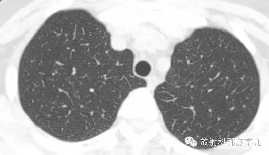 HRCT肺间质性改变的表现及意义
