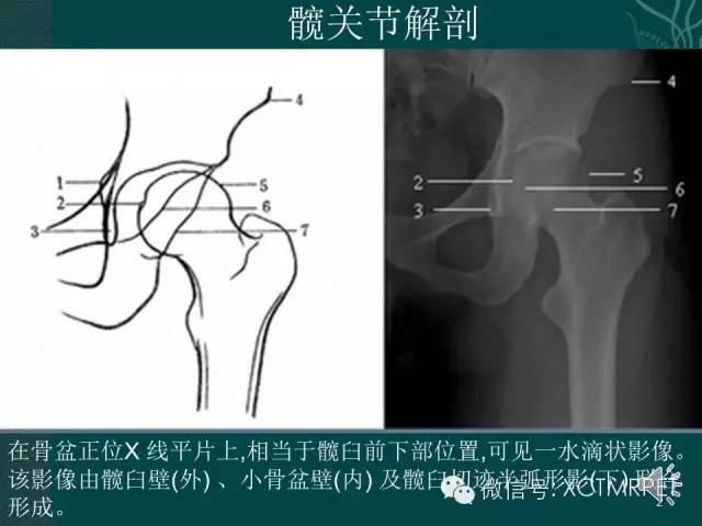 髋关节部分疾病影像学表现