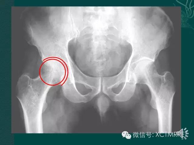 髋关节部分疾病影像学表现