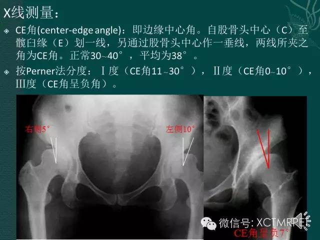 髋关节部分疾病影像学表现