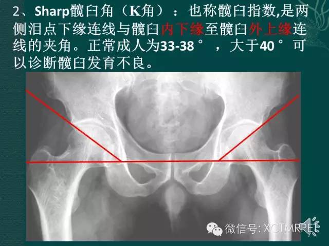 髋关节部分疾病影像学表现