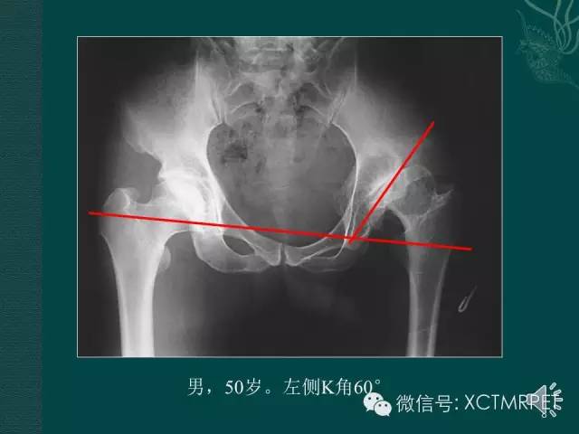 髋关节部分疾病影像学表现