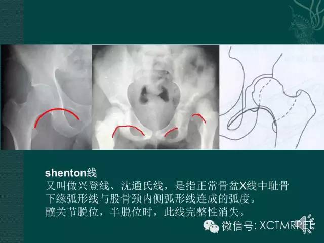 髋关节部分疾病影像学表现
