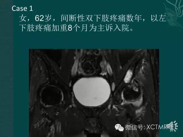 髋关节部分疾病影像学表现