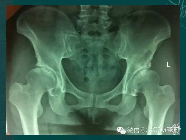 髋关节部分疾病影像学表现