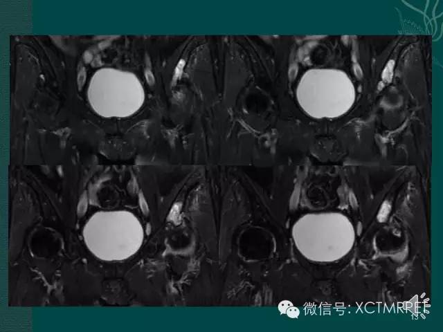 髋关节部分疾病影像学表现