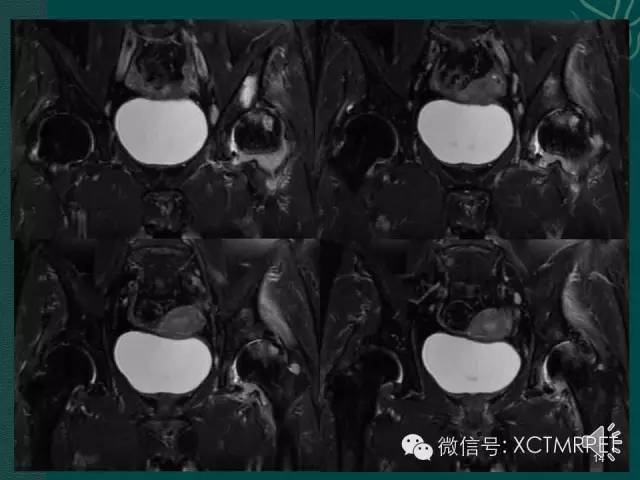 髋关节部分疾病影像学表现