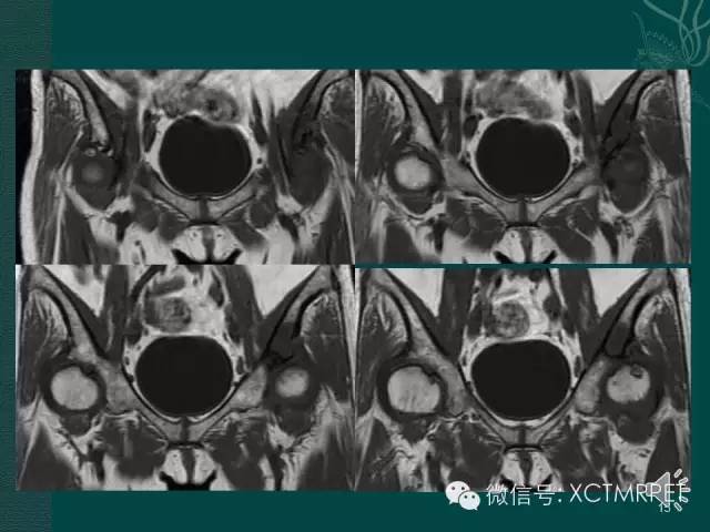 髋关节部分疾病影像学表现