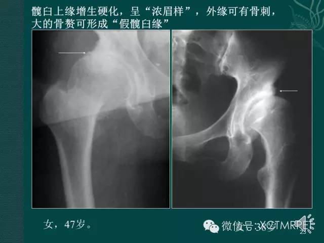 髋关节部分疾病影像学表现