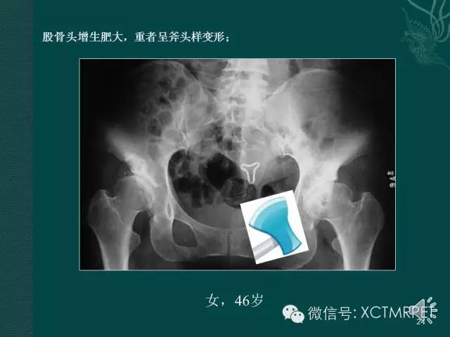 髋关节部分疾病影像学表现