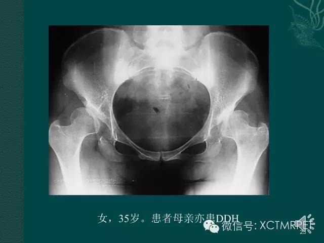 髋关节部分疾病影像学表现
