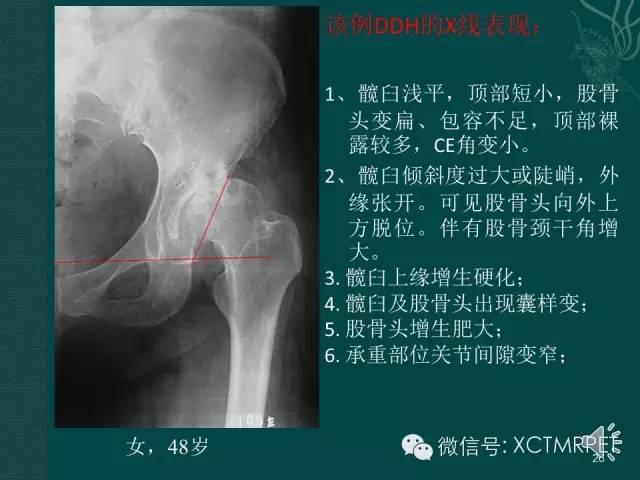 髋关节部分疾病影像学表现