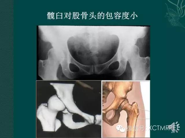 髋关节部分疾病影像学表现