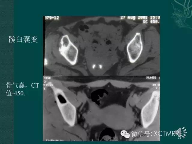 髋关节部分疾病影像学表现