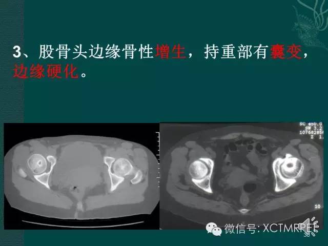 髋关节部分疾病影像学表现