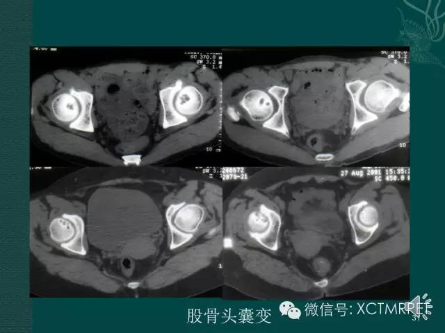 髋关节部分疾病影像学表现