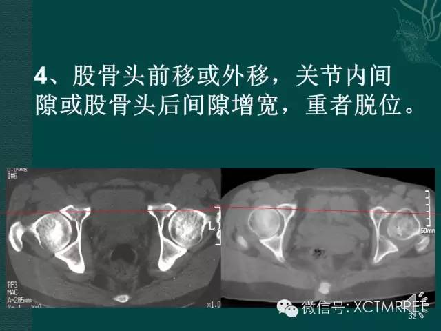 髋关节部分疾病影像学表现