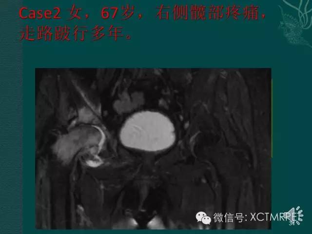 髋关节部分疾病影像学表现