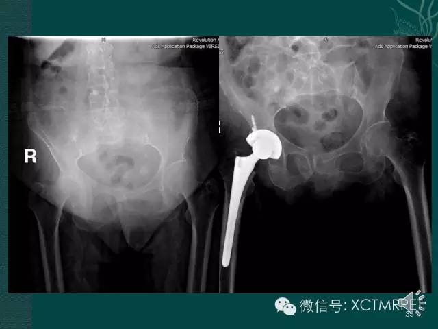 髋关节部分疾病影像学表现