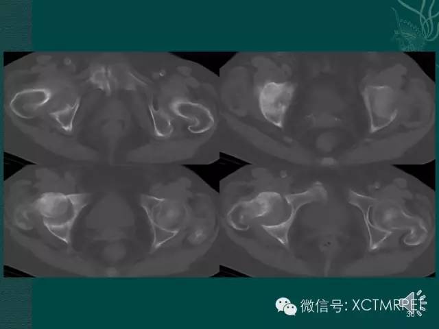 髋关节部分疾病影像学表现