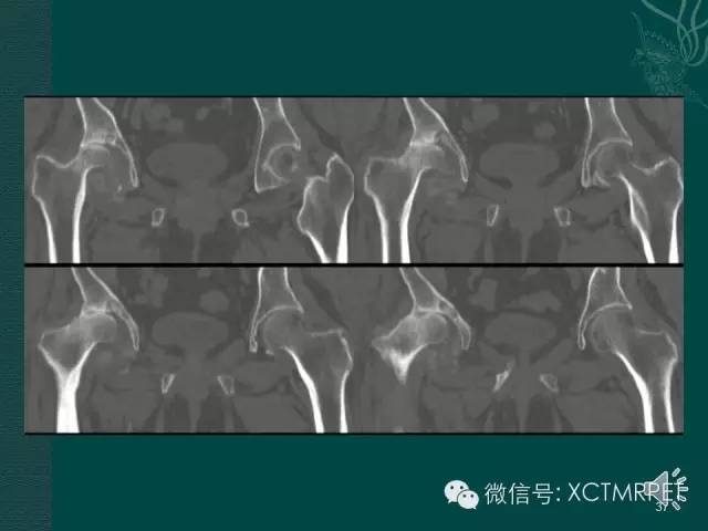 髋关节部分疾病影像学表现