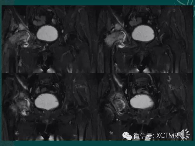 髋关节部分疾病影像学表现