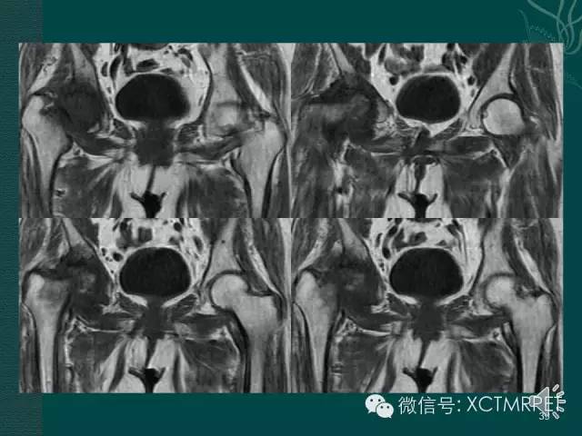 髋关节部分疾病影像学表现