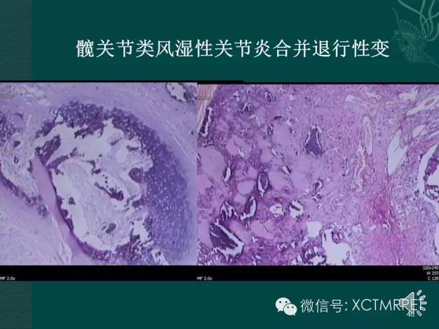 髋关节部分疾病影像学表现