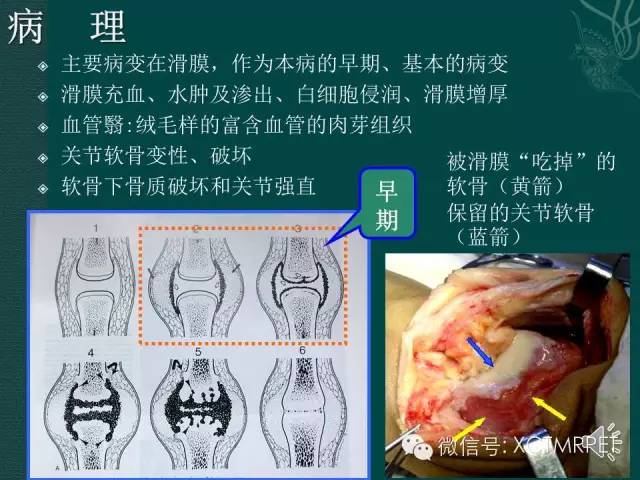 髋关节部分疾病影像学表现