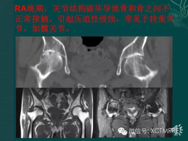 髋关节部分疾病影像学表现