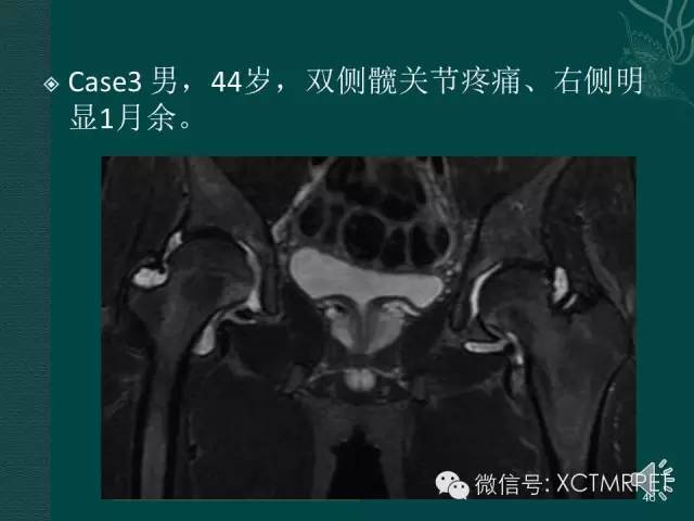 髋关节部分疾病影像学表现