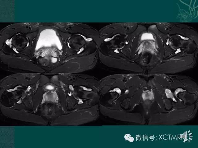 髋关节部分疾病影像学表现