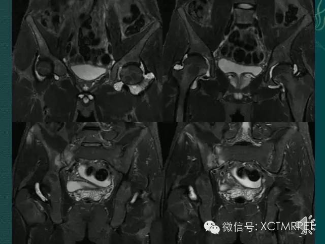 髋关节部分疾病影像学表现