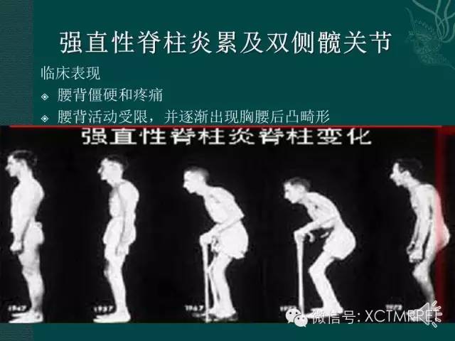 髋关节部分疾病影像学表现