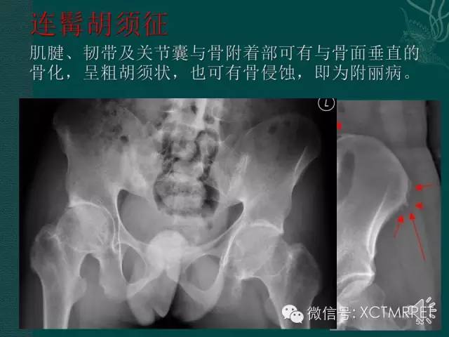 髋关节部分疾病影像学表现