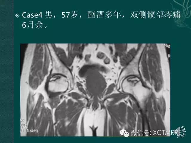 髋关节部分疾病影像学表现