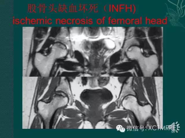 髋关节部分疾病影像学表现