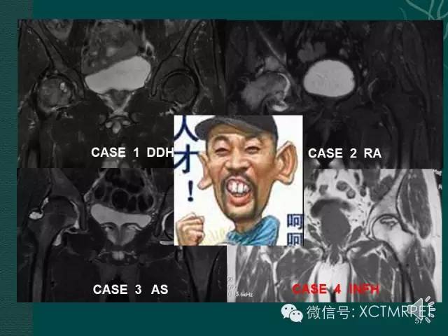 髋关节部分疾病影像学表现