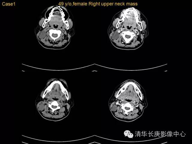 【病例】鳃裂囊肿1例CT影像表现