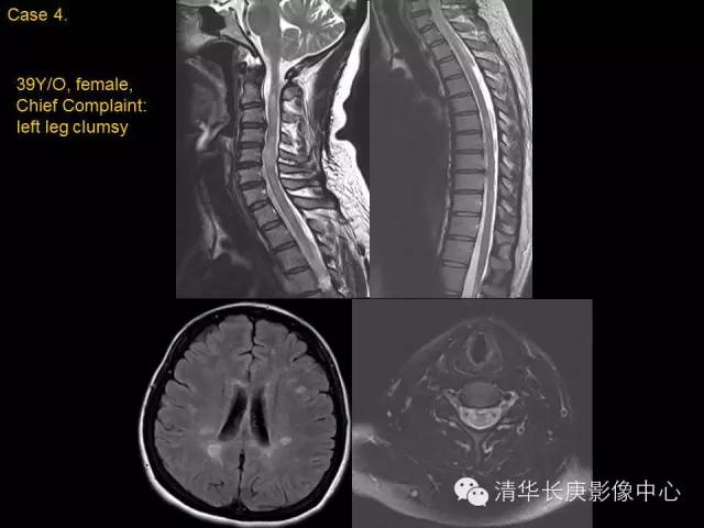 【病例】多发性硬化1例MR影像表现