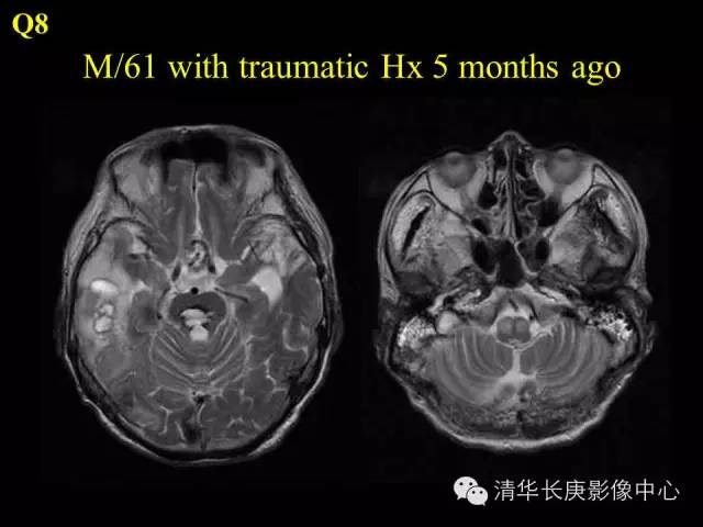 【病例】肥大性下橄榄核变性1例MR影像表现