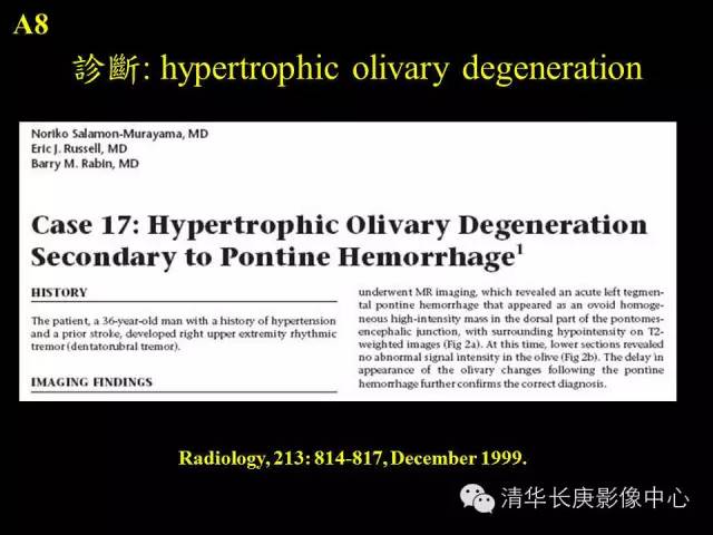 【病例】肥大性下橄榄核变性1例MR影像表现