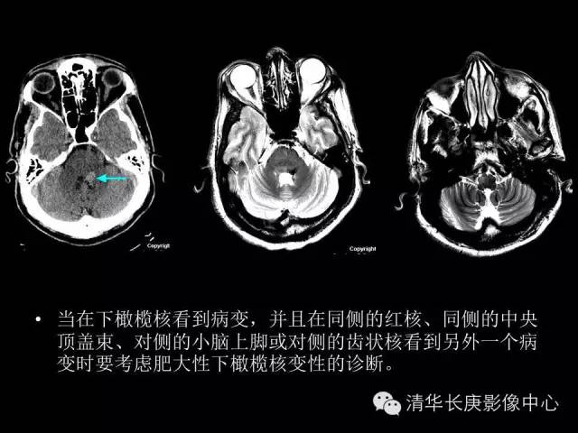 【病例】肥大性下橄榄核变性1例MR影像表现