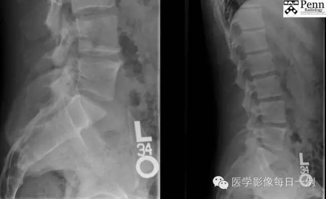 【病例】强直性脊柱炎1例影像表现