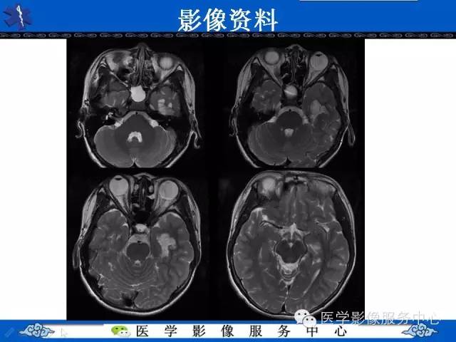 【病例】胚胎发育不良性神经上皮肿瘤DNET一例MR影像表现