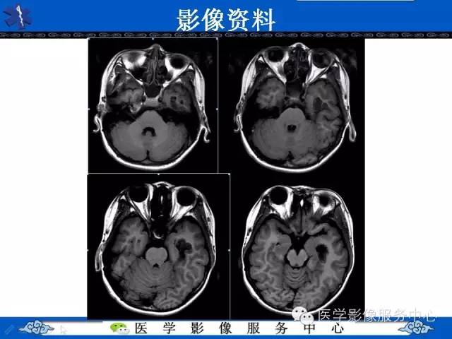 【病例】胚胎发育不良性神经上皮肿瘤DNET一例MR影像表现