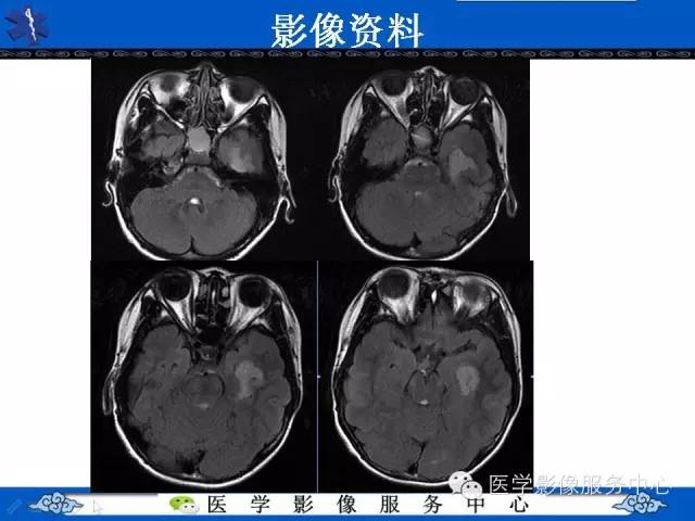 【病例】胚胎发育不良性神经上皮肿瘤DNET一例MR影像表现